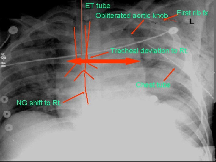 ET tube Obliterated aortic knob First rib fx Tracheal deviation to Rt. Chest tube