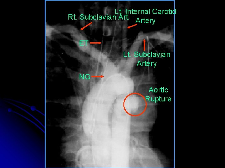 Lt. Internal Carotid Rt. Subclavian Artery ET Lt. Subclavian Artery NG Aortic Rupture 