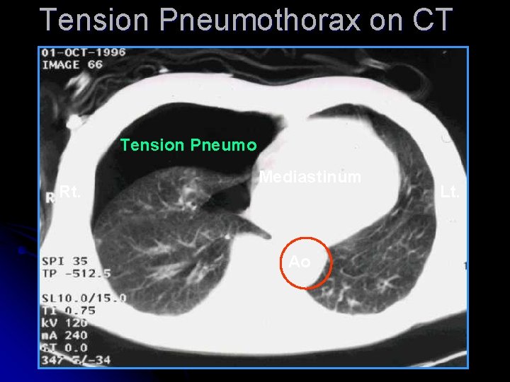 Tension Pneumothorax on CT Tension Pneumo Rt. Mediastinum Ao Lt. 