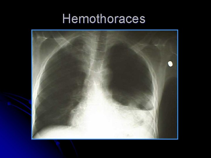 Hemothoraces 
