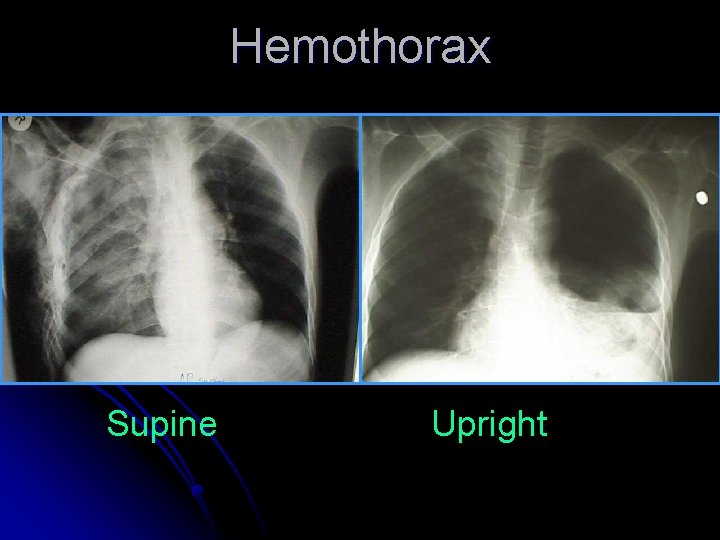 Hemothorax Supine Upright 