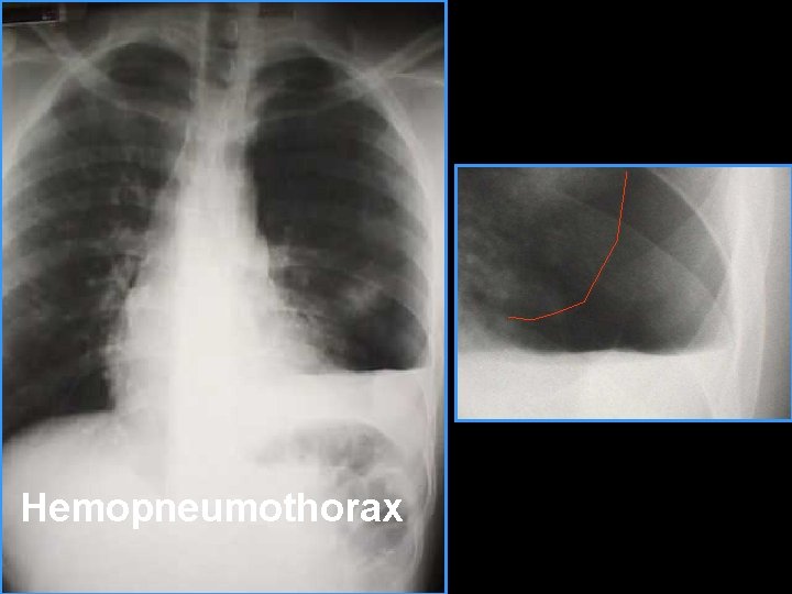 Hemopneumothorax 