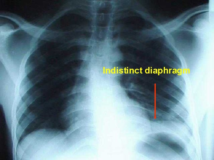 Indistinct diaphragm 