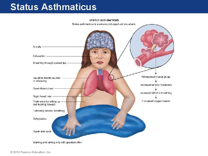 Status Asthmaticus © 2012 Pearson Education, Inc. Status Asthmaticus © 2012 Pearson Education, Inc.