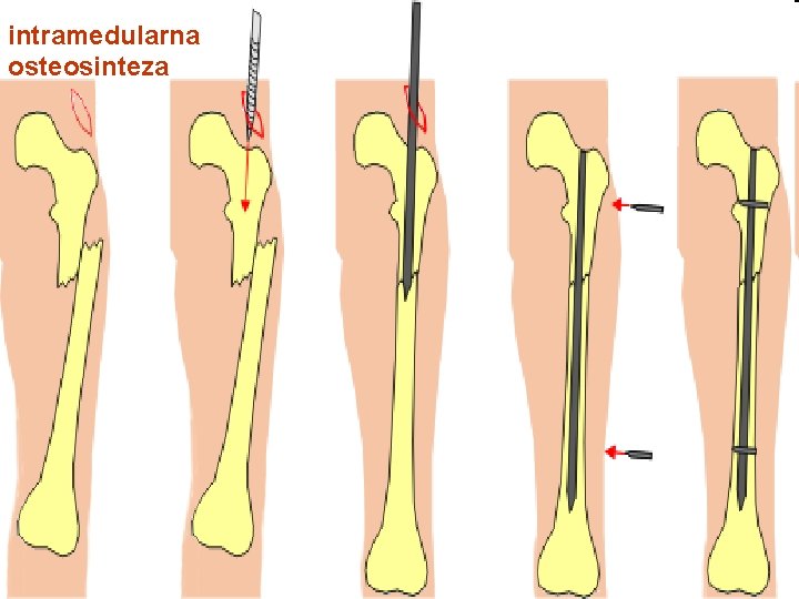 bursita artrita reumatoida a articulatiei cotului artrita arterei genunchiului tratamentul simptomelor