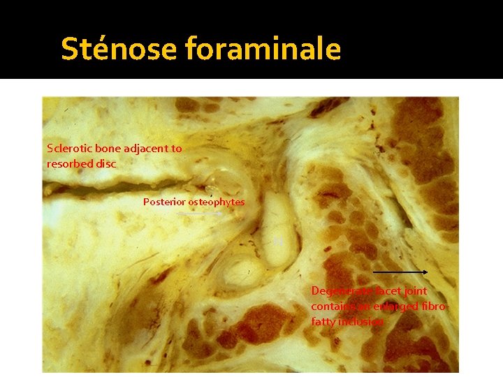  Sténose foraminale Sclerotic bone adjacent to resorbed disc Posterior osteophytes N Degenerate facet