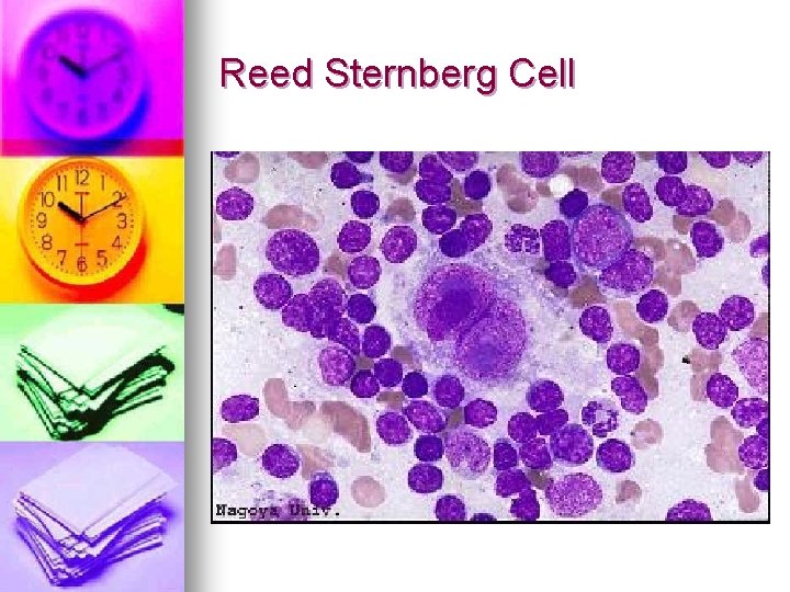 Reed Sternberg Cell 