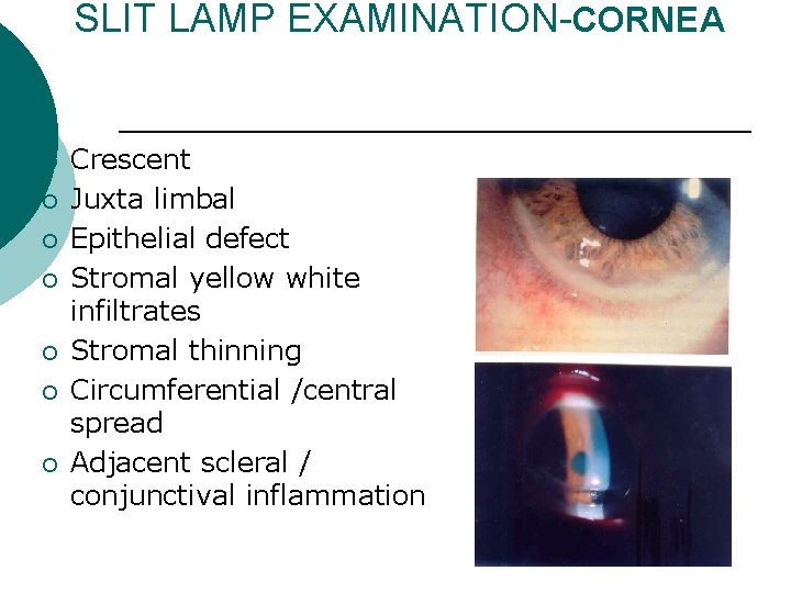 SLIT LAMP EXAMINATION-CORNEA ¡ ¡ ¡ ¡ Crescent Juxta limbal Epithelial defect Stromal yellow