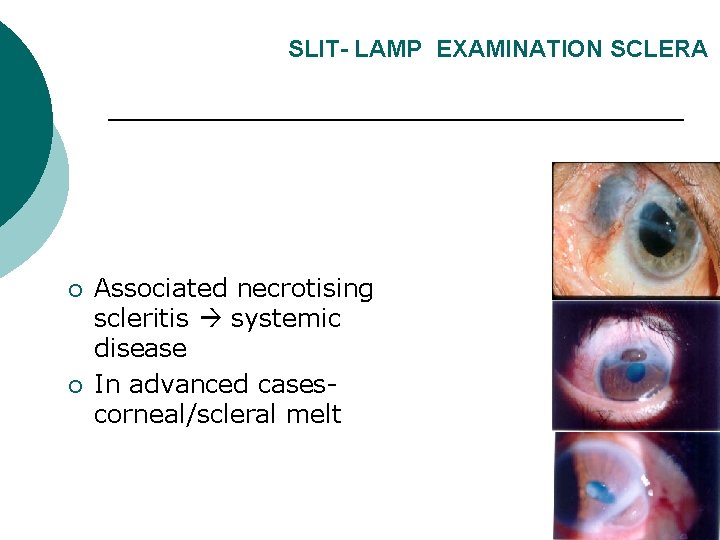 SLIT- LAMP EXAMINATION SCLERA ¡ ¡ Associated necrotising scleritis systemic disease In advanced casescorneal/scleral