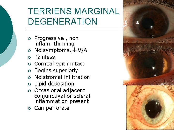 TERRIENS MARGINAL DEGENERATION ¡ ¡ ¡ ¡ ¡ Progressive , non inflam. thinning No