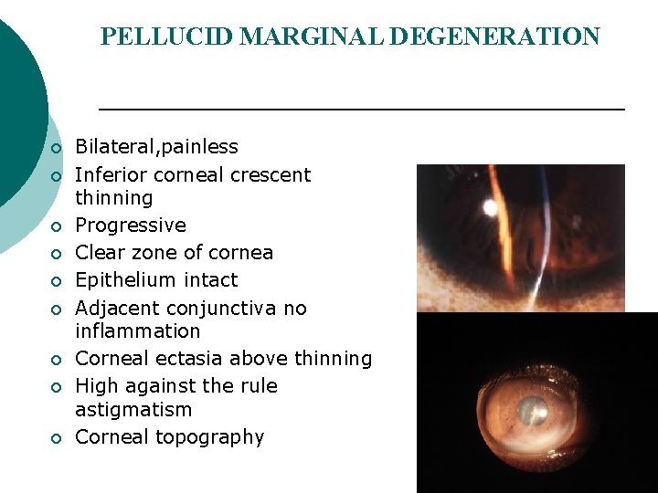 PELLUCID MARGINAL DEGENERATION ¡ ¡ ¡ ¡ ¡ Bilateral, painless Inferior corneal crescent thinning
