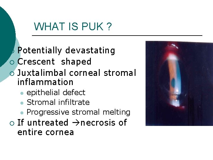 WHAT IS PUK ? Potentially devastating ¡ Crescent shaped ¡ Juxtalimbal corneal stromal inflammation