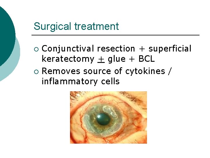 Surgical treatment Conjunctival resection + superficial keratectomy + glue + BCL ¡ Removes source