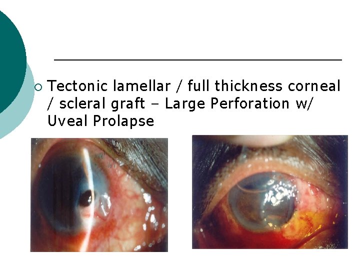 ¡ Tectonic lamellar / full thickness corneal / scleral graft – Large Perforation w/