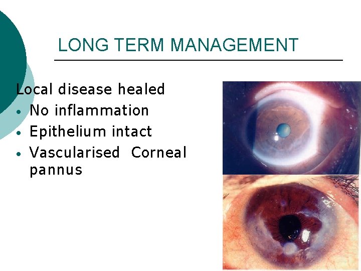 LONG TERM MANAGEMENT Local disease healed • No inflammation • Epithelium intact • Vascularised