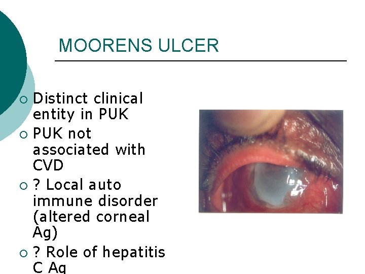 MOORENS ULCER Distinct clinical entity in PUK ¡ PUK not associated with CVD ¡