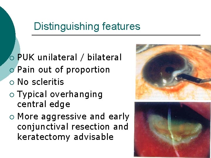 Distinguishing features PUK unilateral / bilateral ¡ Pain out of proportion ¡ No scleritis