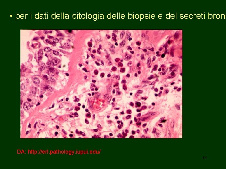  • per i dati della citologia delle biopsie e del secreti bronc DA: