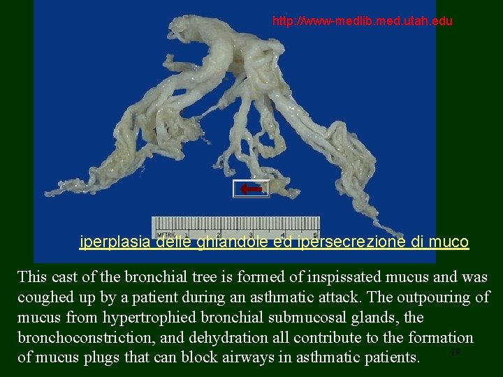 http: //www-medlib. med. utah. edu delle ghiandole ed ipersecrezione di muco iperplasia This cast