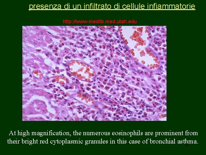 presenza di un infiltrato di cellule infiammatorie http: //www-medlib. med. utah. edu At high