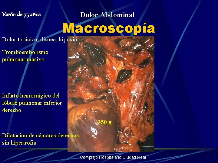 Varón de 75 años Dolor Abdominal Macroscopía Dolor torácico, disnea, hipoxia Tromboembolismo pulmonar masivo