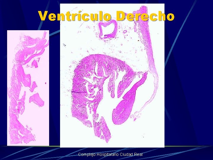 Ventrículo Derecho Complejo Hospitalario Ciudad Real 