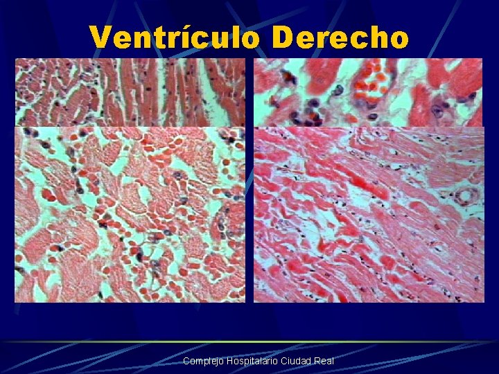 Ventrículo Derecho Complejo Hospitalario Ciudad Real 