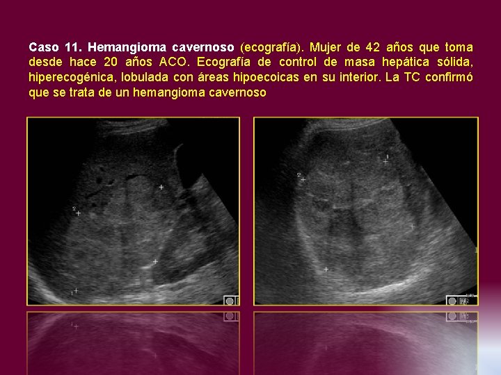 Caso 11. Hemangioma cavernoso (ecografía). Mujer de 42 años que toma desde hace 20