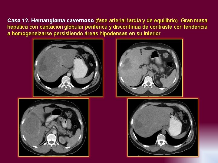 Caso 12. Hemangioma cavernoso (fase arterial tardía y de equilibrio). Gran masa hepática con