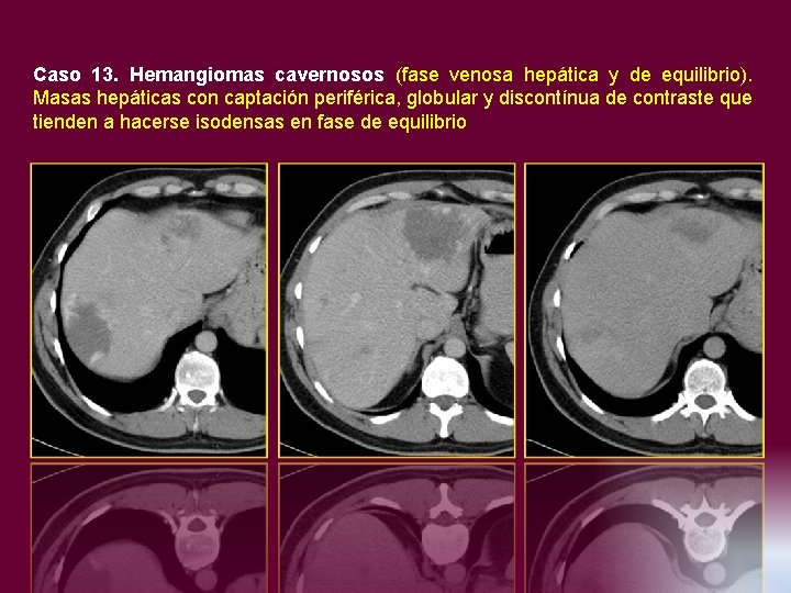 Caso 13. Hemangiomas cavernosos (fase venosa hepática y de equilibrio). Masas hepáticas con captación