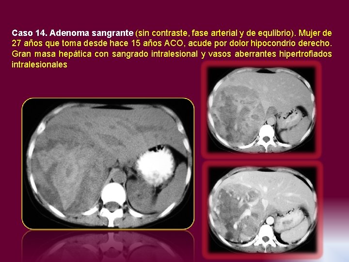 Caso 14. Adenoma sangrante (sin contraste, fase arterial y de equlibrio). Mujer de 27