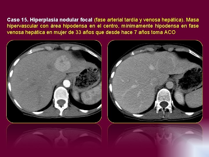 Caso 15. Hiperplasia nodular focal (fase arterial tardía y venosa hepática). Masa hipervascular con