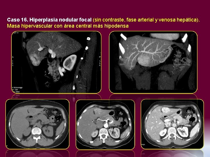 Caso 16. Hiperplasia nodular focal (sin contraste, fase arterial y venosa hepática). Masa hipervascular