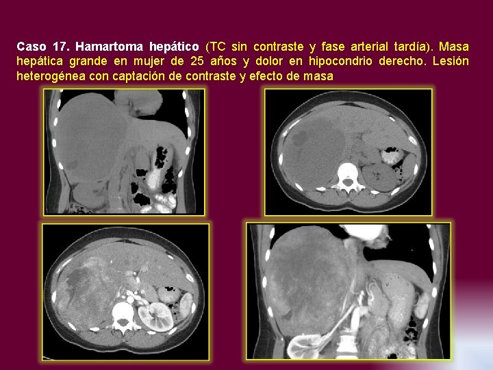 Caso 17. Hamartoma hepático (TC sin contraste y fase arterial tardía). Masa hepática grande