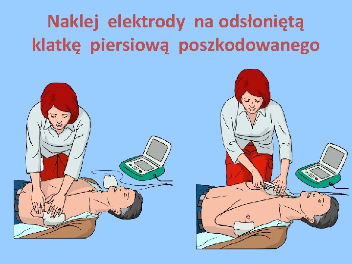 Naklej elektrody na odsłoniętą klatkę piersiową poszkodowanego 