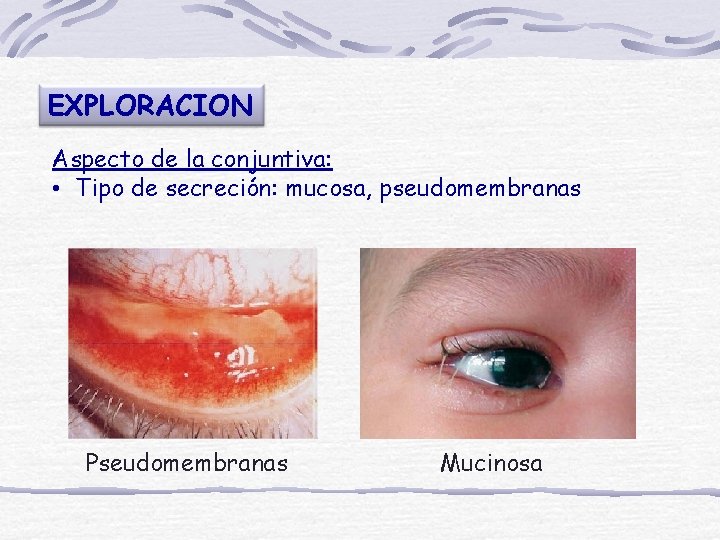 EXPLORACION Aspecto de la conjuntiva: • Tipo de secreción: mucosa, pseudomembranas Pseudomembranas Mucinosa 