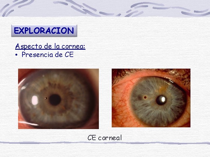 EXPLORACION Aspecto de la cornea: • Presencia de CE CE corneal 