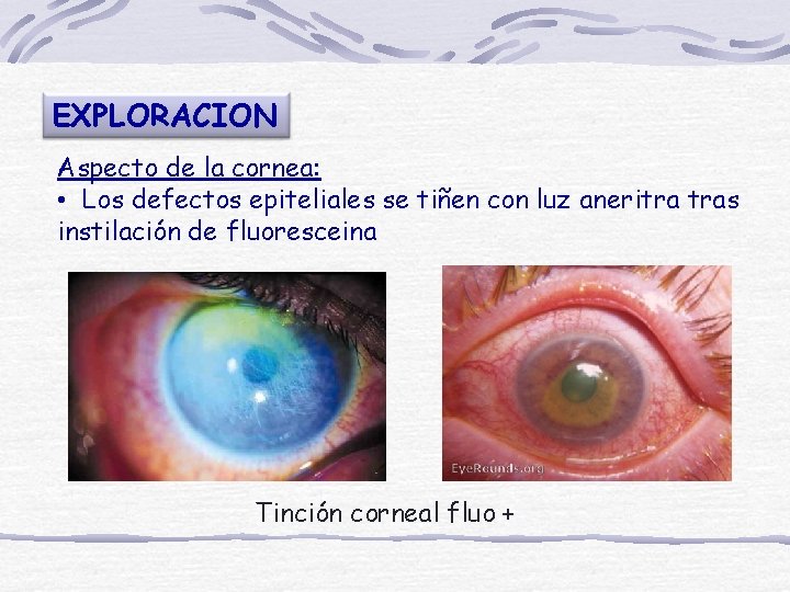 EXPLORACION Aspecto de la cornea: • Los defectos epiteliales se tiñen con luz aneritra