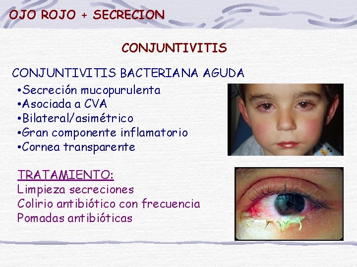 OJO ROJO + SECRECION CONJUNTIVITIS BACTERIANA AGUDA • Secreción mucopurulenta • Asociada a CVA