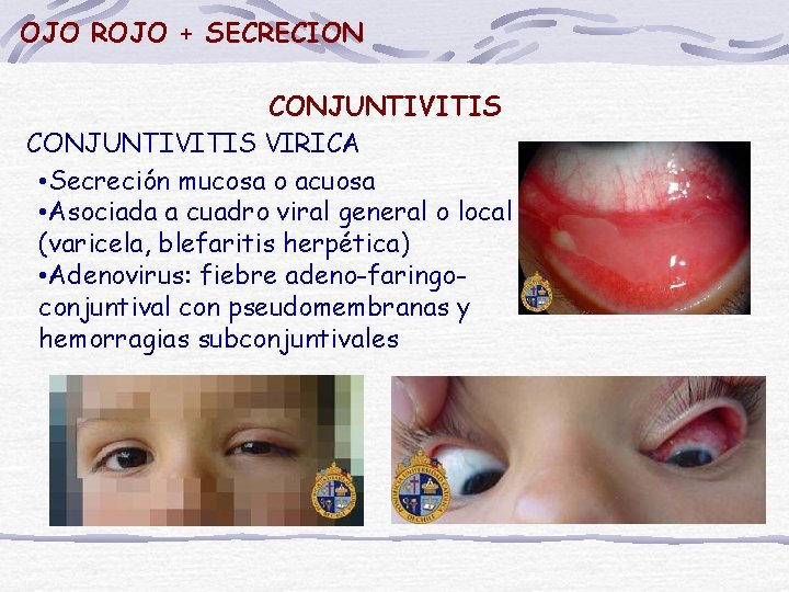 OJO ROJO + SECRECION CONJUNTIVITIS VIRICA • Secreción mucosa o acuosa • Asociada a