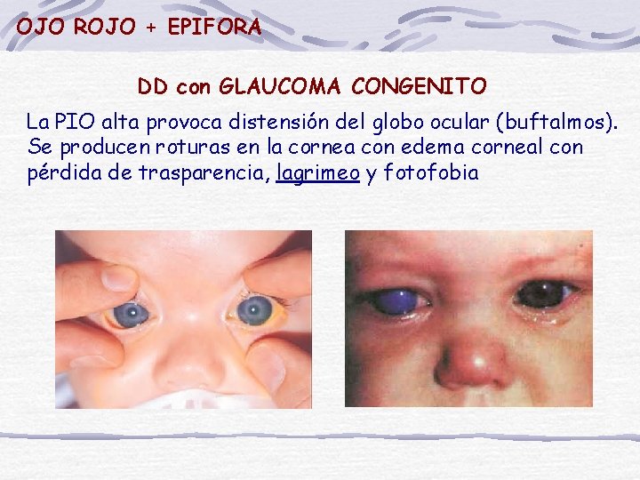 OJO ROJO + EPIFORA DD con GLAUCOMA CONGENITO La PIO alta provoca distensión del