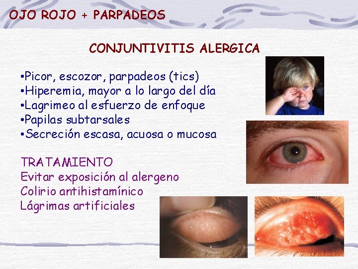 OJO ROJO + PARPADEOS CONJUNTIVITIS ALERGICA • Picor, escozor, parpadeos (tics) • Hiperemia, mayor