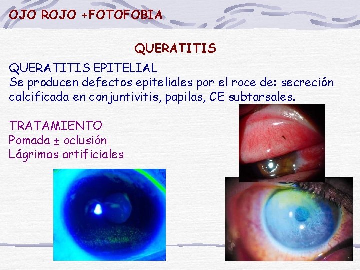 OJO ROJO +FOTOFOBIA QUERATITIS EPITELIAL Se producen defectos epiteliales por el roce de: secreción