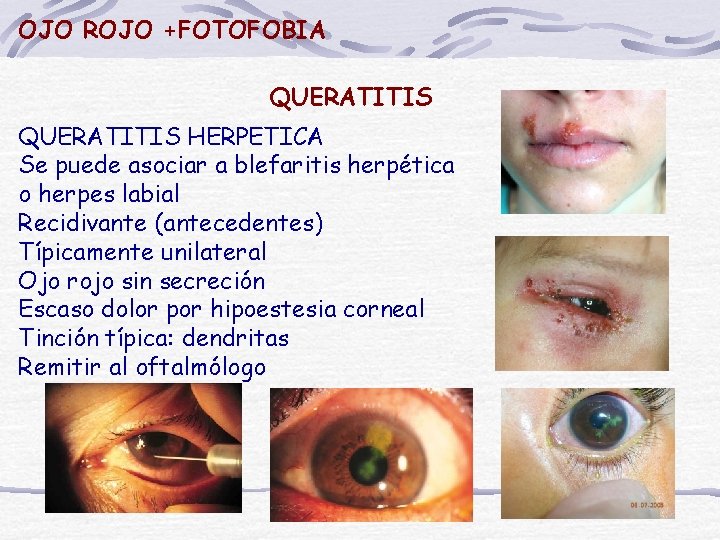OJO ROJO +FOTOFOBIA QUERATITIS HERPETICA Se puede asociar a blefaritis herpética o herpes labial
