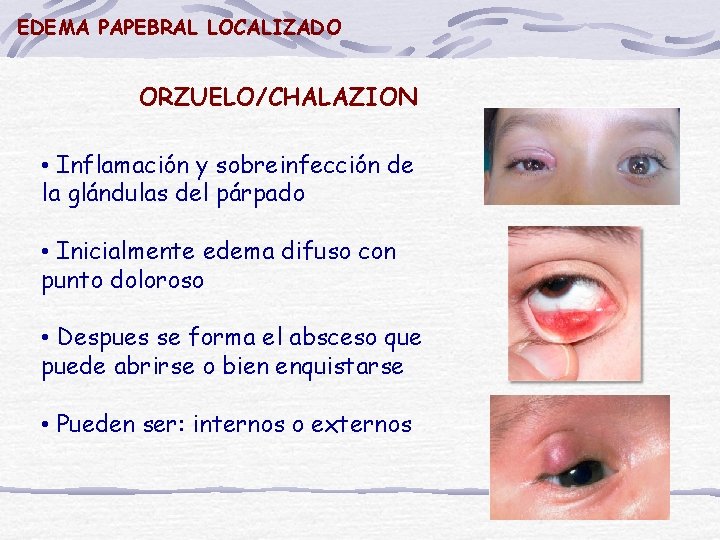 EDEMA PAPEBRAL LOCALIZADO ORZUELO/CHALAZION • Inflamación y sobreinfección de la glándulas del párpado •