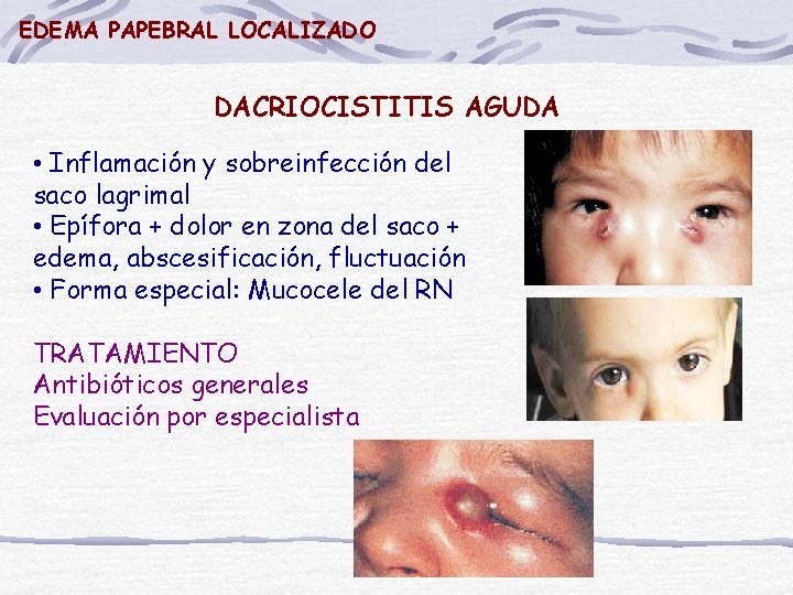 EDEMA PAPEBRAL LOCALIZADO DACRIOCISTITIS AGUDA • Inflamación y sobreinfección del saco lagrimal • Epífora