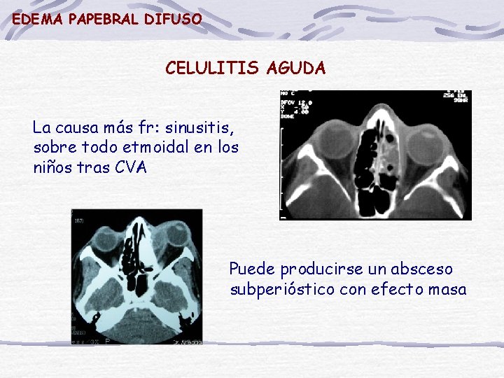 EDEMA PAPEBRAL DIFUSO CELULITIS AGUDA La causa más fr: sinusitis, sobre todo etmoidal en