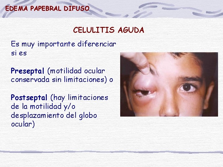 EDEMA PAPEBRAL DIFUSO CELULITIS AGUDA Es muy importante diferenciar si es Preseptal (motilidad ocular