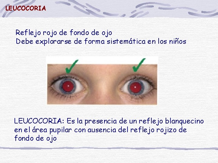LEUCOCORIA Reflejo rojo de fondo de ojo Debe explorarse de forma sistemática en los