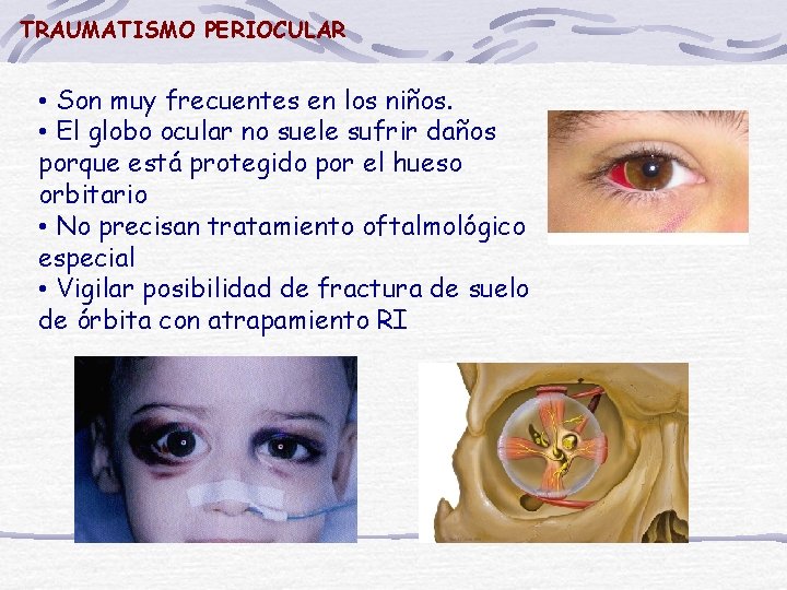 TRAUMATISMO PERIOCULAR • Son muy frecuentes en los niños. • El globo ocular no